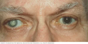 Health & Fitness Cataract treatment under a doctor's advice.